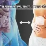 नसों में गैस बनना कारण, लक्षण, उपचार और बचाव