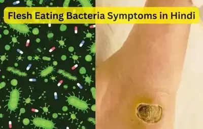 Flesh Eating Bacteria Symptoms in Hindi